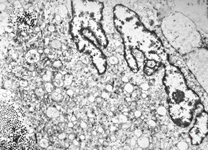 F,68y. | xanthomatous cell in atherosclerotic plaque - a. vertebralis F,68y. | xanthomatous cell in atherosclerotic plaque - a. vertebralis